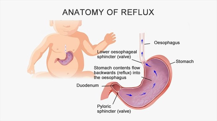 Acid Reflux Disease in Infants