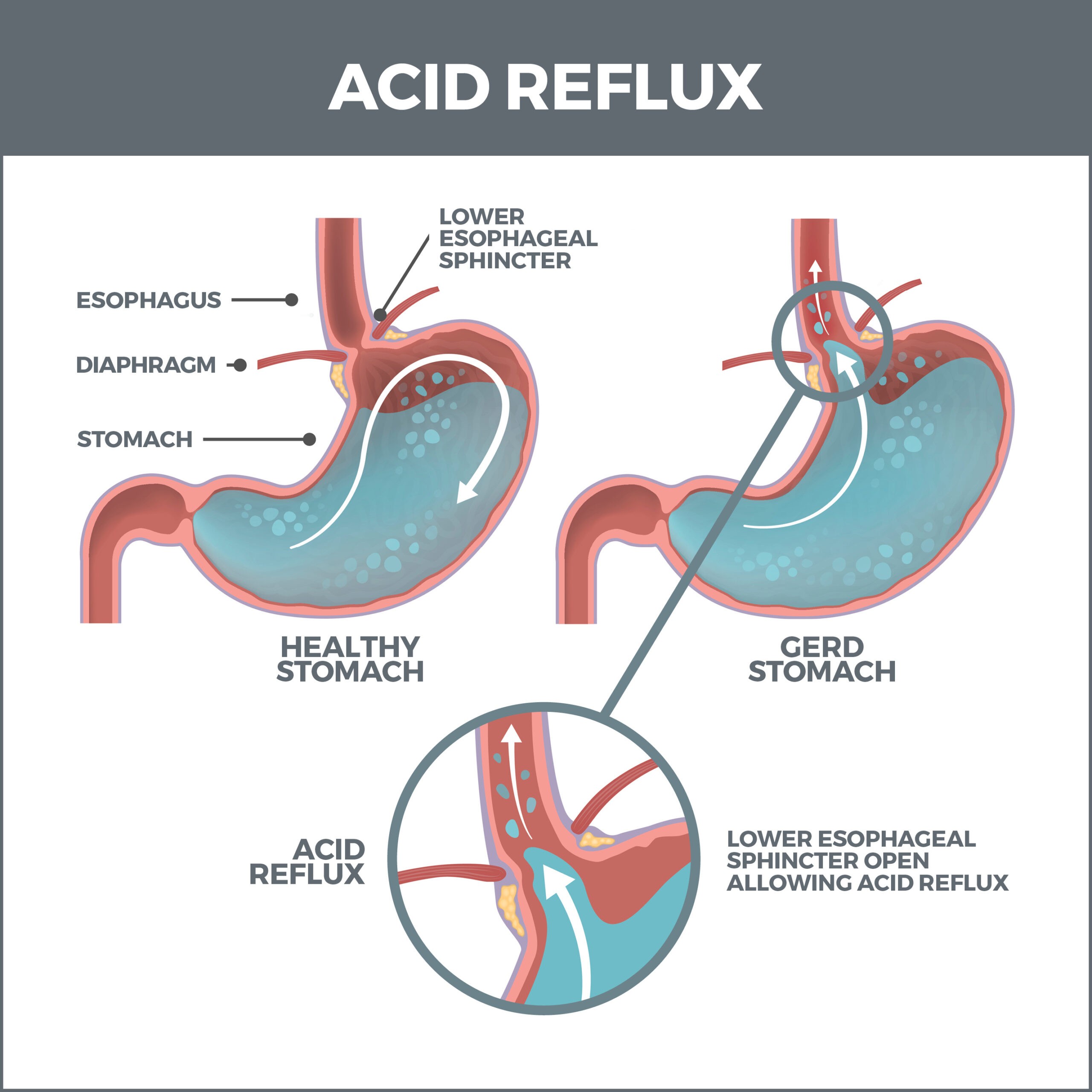 Acid Reflux Disease
