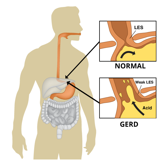 What Is Acid Reflux Or Gerd?